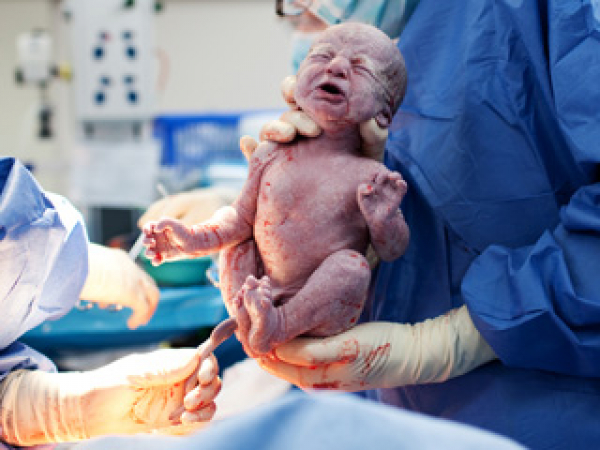 Um bebê nascido por cesárea 